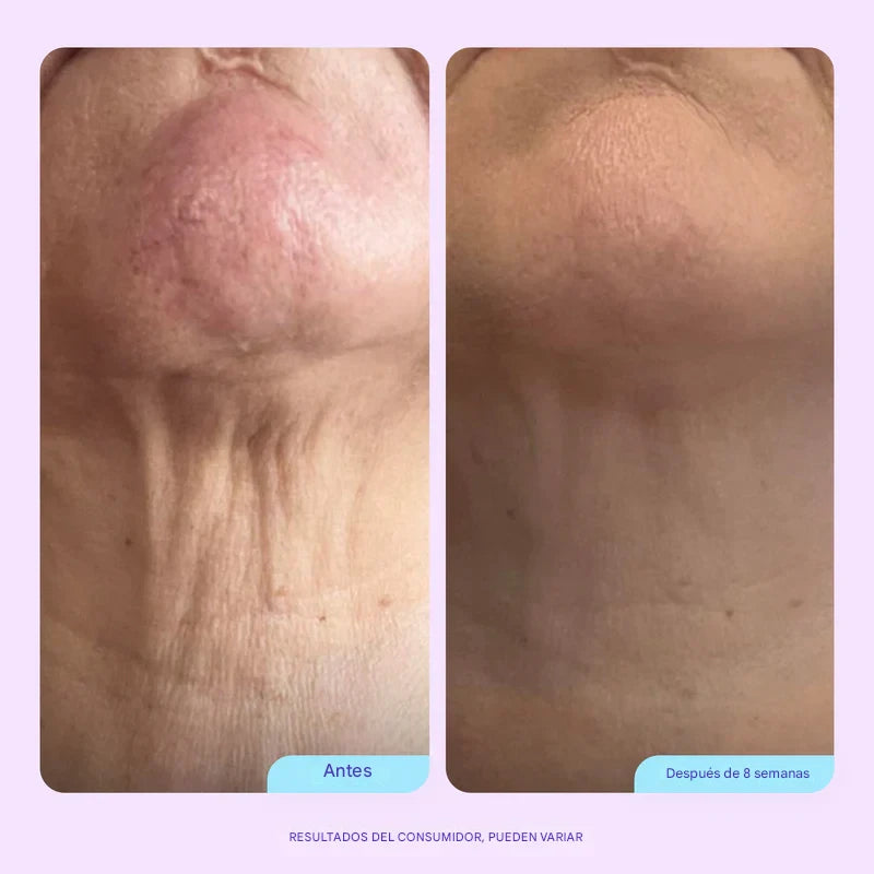 Crema Tensora Cuello & Papada - Adiós arrugas, flacidez y “cuello de pavo” en 4 semanas.